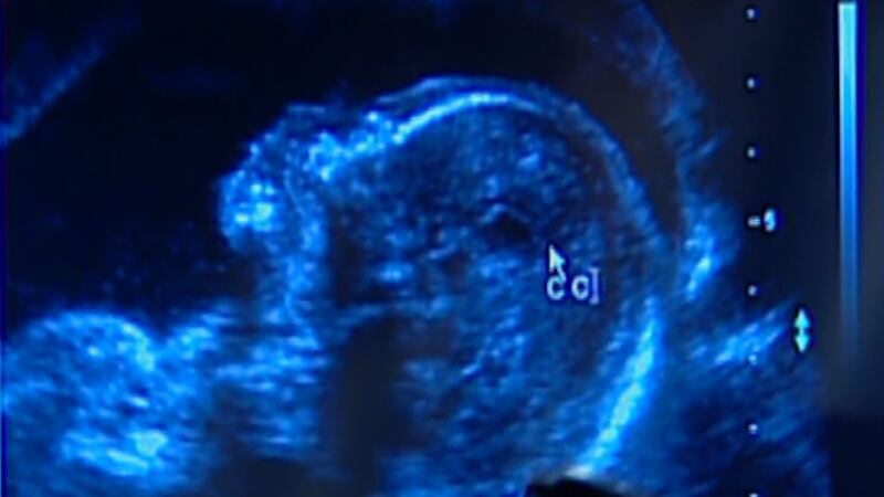 FILE: A sonogram of a fetus is shown in this file photo. According to CDC data, fewer...