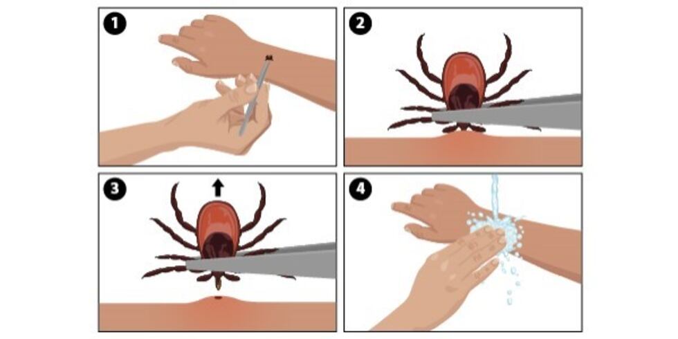 Using the proper technique and tools to remove ticks is vital.